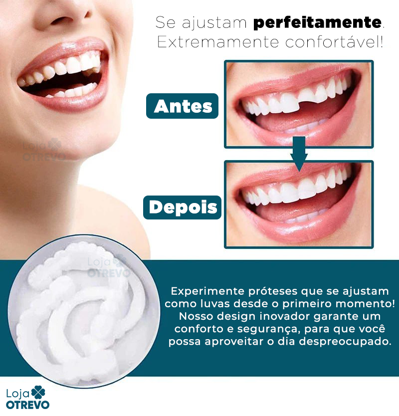 SmileFit - Facetas Dentárias Naturais Removíveis (Superior e Inferior)