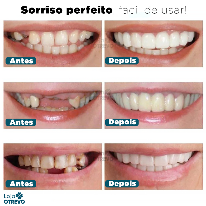 SmileFit - Facetas Dentárias Naturais Removíveis (Superior e Inferior)